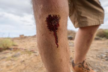 Close-up of a bleeding wound on a man's leg, outdoors with rocky terrain in the background. Hiking and Travel concept image- Stock Photo or Stock Video of rcfotostock | RC Photo Stock