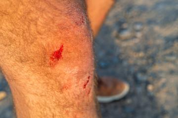 Close-up of a scraped and bloody knee with leg hair- Stock Photo or Stock Video of rcfotostock | RC Photo Stock