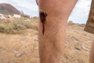 fresh bleeding wound on a man's leg with a blurred desert-like background. Hiking and Travel concept image- Stock Photo or Stock Video of rcfotostock | RC Photo Stock