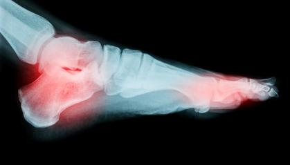 human foot ankel and leg xray picture- Stock Photo or Stock Video of rcfotostock | RC Photo Stock