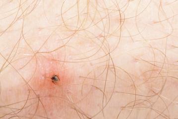 Tick Ixodes ricinus on human skin : Stock Photo or Stock Video Download rcfotostock photos, images and assets rcfotostock | RC Photo Stock.: