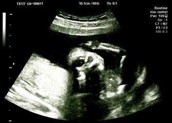 Turning Baby head on ultrasound scan in hospital check. Echography Scan.- Stock Photo or Stock Video of rcfotostock | RC-Photo-Stock