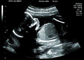 Ultrasound of baby in a mothers womb- Stock Photo or Stock Video of rcfotostock | RC Photo Stock