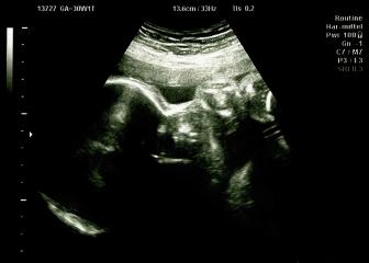 Ultrasound of baby in mother's womb. Echography Scan.- Stock Photo or Stock Video of rcfotostock | RC-Photo-Stock