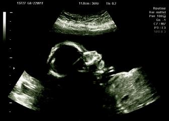 Ultrasound scan of baby in mother's womb at a hospital check- Stock Photo or Stock Video of rcfotostock | RC-Photo-Stock