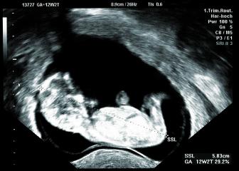 Ultrasound small baby at 12 weeks. 12 weeks pregnant ultrasound image show baby or fetus development and pregnancy health checking at a Hospital- Stock Photo or Stock Video of rcfotostock | RC-Photo-Stock