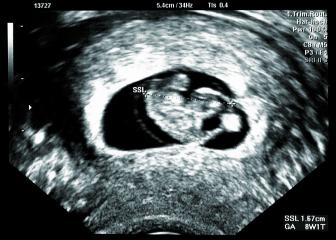Ultrasound small baby at 8 weeks. 8 weeks pregnant ultrasound image show baby or fetus development and pregnancy health checking at a Hospital- Stock Photo or Stock Video of rcfotostock | RC-Photo-Stock