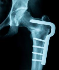 X-Ray Image of a broken pelvis/hip with metal pins holding it together- Stock Photo or Stock Video of rcfotostock | RC-Photo-Stock