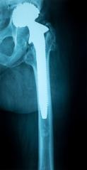 X-Ray Image of a Human Chest with Artificial hip joint- Stock Photo or Stock Video of rcfotostock | RC Photo Stock