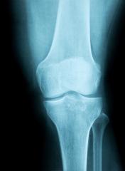 X-Ray Image of a Human knee joint - Stock Photo or Stock Video of rcfotostock | RC-Photo-Stock