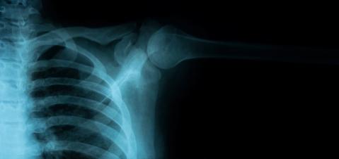 X-Ray Image of Healthy Chest- Stock Photo or Stock Video of rcfotostock | RC Photo Stock
