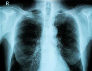 X-Ray Image Of Human Chest- Stock Photo or Stock Video of rcfotostock | RC Photo Stock