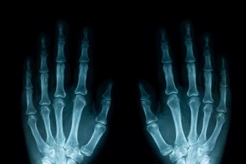 x-ray image of left and right human hands- Stock Photo or Stock Video of rcfotostock | RC-Photo-Stock