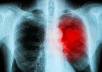 x-ray red heart of human (heart disease)- Stock Photo or Stock Video of rcfotostock | RC-Photo-Stock