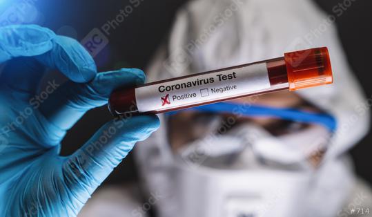 2019-nCoV Coronavirus Test. Positive Blood Sample in Scientist Hand. Respiratory Syndrome. Coronavirus outbreaking  : Stock Photo or Stock Video Download rcfotostock photos, images and assets rcfotostock | RC Photo Stock.: