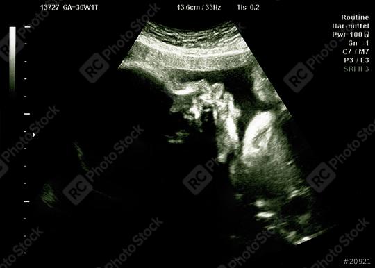 Baby head on ultrasound scan in hospital check, Echography Scan  : Stock Photo or Stock Video Download rcfotostock photos, images and assets rcfotostock | RC Photo Stock.: