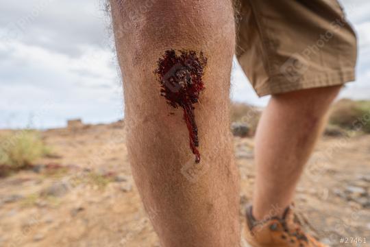 Close-up of a bleeding wound on a man