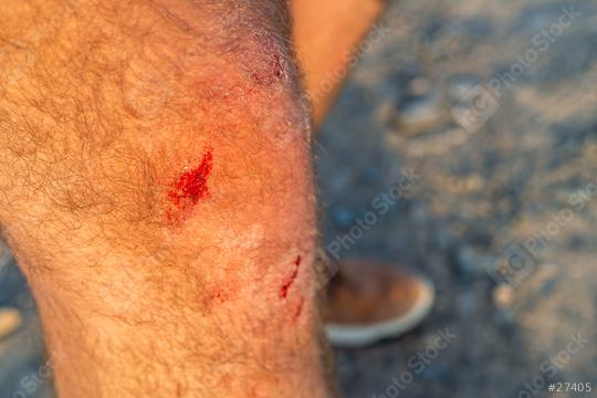 Close-up of a scraped and bloody knee with leg hair  : Stock Photo or Stock Video Download rcfotostock photos, images and assets rcfotostock | RC Photo Stock.: