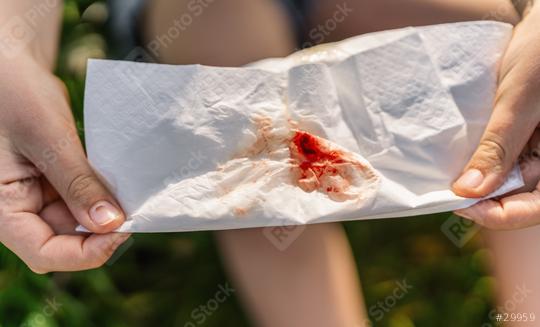 close-up of a tissue stained with blood held by a young girl, indicating a nosebleed. The background is blurred, emphasizing the medical condition and the need for care and attention.  : Stock Photo or Stock Video Download rcfotostock photos, images and assets rcfotostock | RC Photo Stock.: