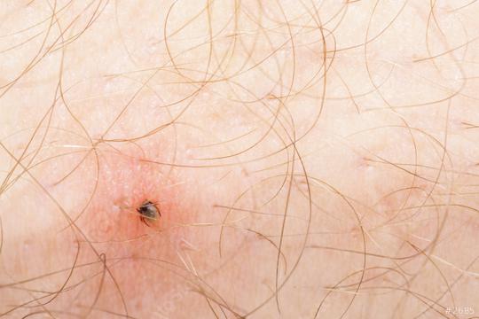 Tick Ixodes ricinus on human skin  : Stock Photo or Stock Video Download rcfotostock photos, images and assets rcfotostock | RC Photo Stock.: