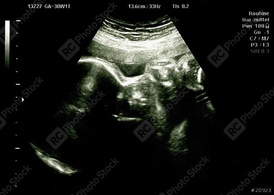 Ultrasound of baby in mother