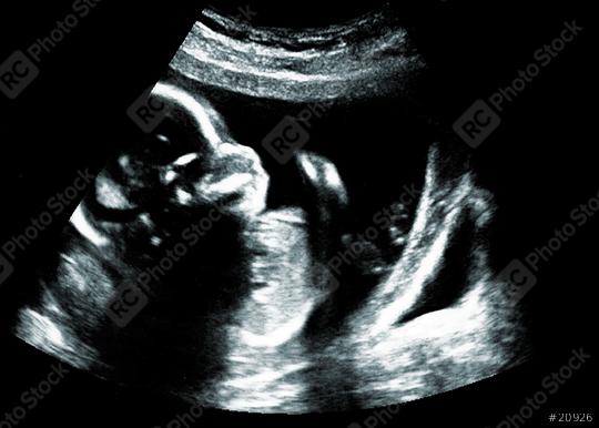 Ultrasound ofa baby in mother