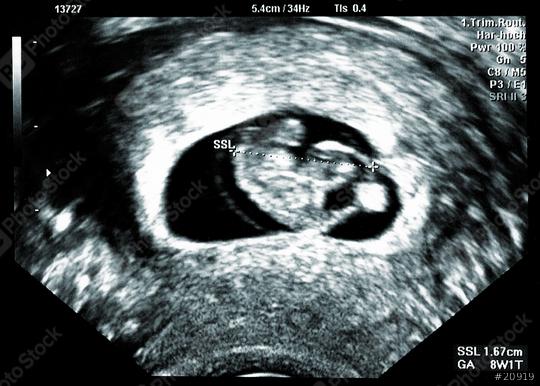 Ultrasound small baby at 8 weeks. 8 weeks pregnant ultrasound image show baby or fetus development and pregnancy health checking at a Hospital  : Stock Photo or Stock Video Download rcfotostock photos, images and assets rcfotostock | RC Photo Stock.: