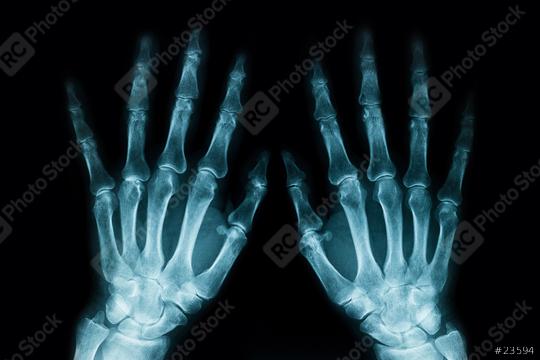 X Ray from hands on black background  : Stock Photo or Stock Video Download rcfotostock photos, images and assets rcfotostock | RC Photo Stock.: