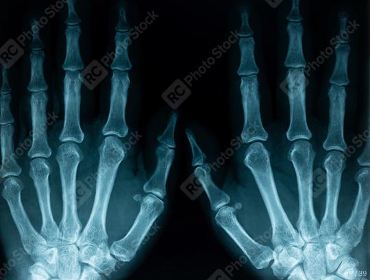 x-ray closeup of hands  : Stock Photo or Stock Video Download rcfotostock photos, images and assets rcfotostock | RC Photo Stock.: