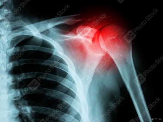 X-ray film of shoulder fracture  : Stock Photo or Stock Video Download rcfotostock photos, images and assets rcfotostock | RC Photo Stock.: