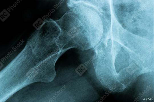 X-Ray Image of a Human Chest hip joint bone   : Stock Photo or Stock Video Download rcfotostock photos, images and assets rcfotostock | RC Photo Stock.: