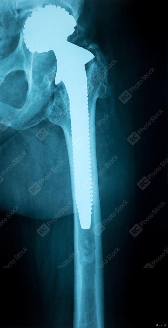 X-Ray Image of a Human Chest with Artificial hip joint  : Stock Photo or Stock Video Download rcfotostock photos, images and assets rcfotostock | RC Photo Stock.:
