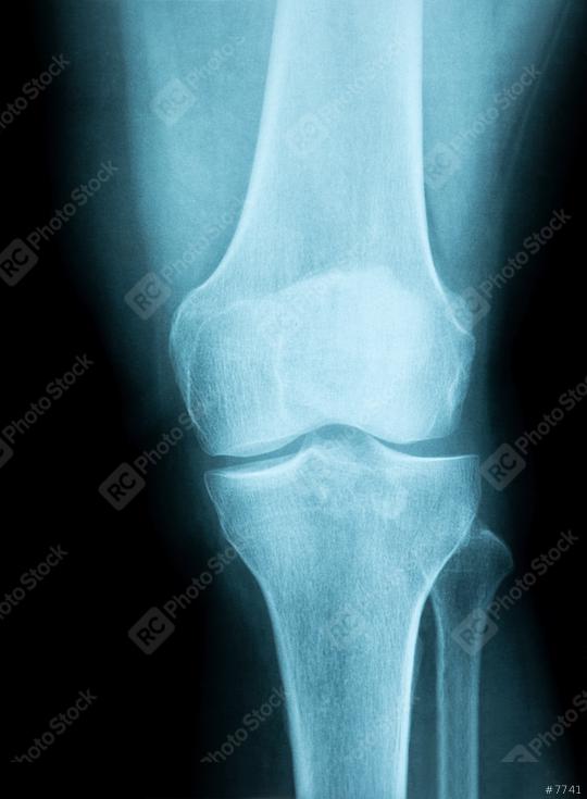 X-Ray Image of a Human knee joint   : Stock Photo or Stock Video Download rcfotostock photos, images and assets rcfotostock | RC Photo Stock.: