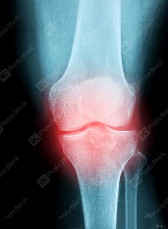 X-Ray Image of a Human knee joint for a medical diagnosis  : Stock Photo or Stock Video Download rcfotostock photos, images and assets rcfotostock | RC Photo Stock.: