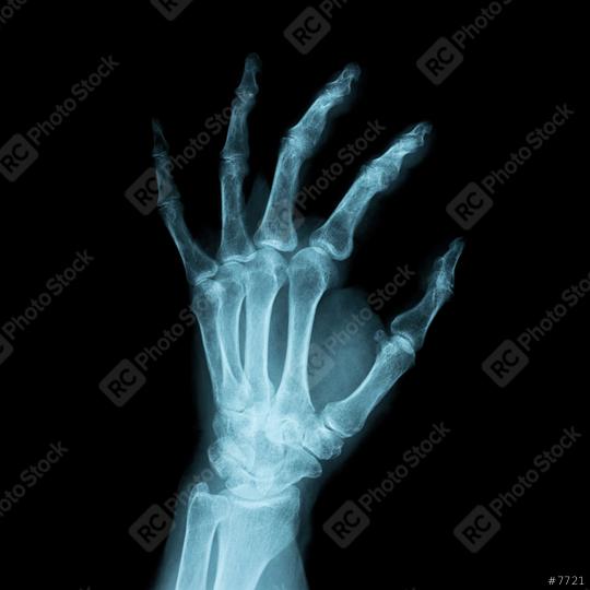 x-ray Image of a human left hand  : Stock Photo or Stock Video Download rcfotostock photos, images and assets rcfotostock | RC Photo Stock.: