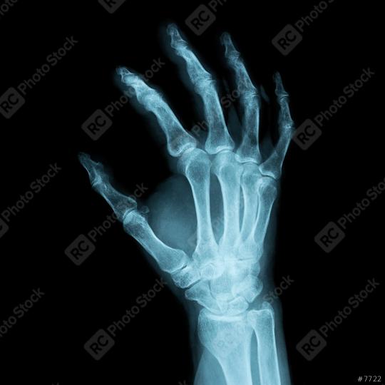 x-ray Image of a human right hand for a medical diagnosis  : Stock Photo or Stock Video Download rcfotostock photos, images and assets rcfotostock | RC Photo Stock.: