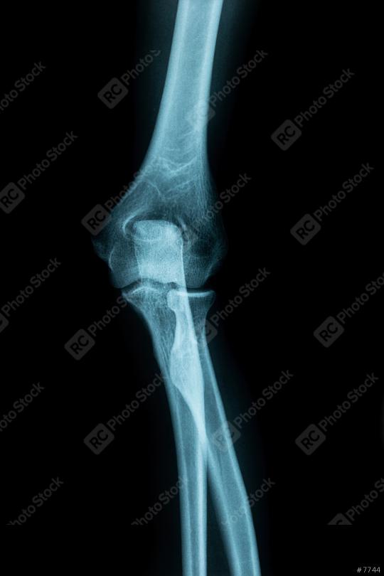 X-Ray Image of a joint for a medical diagnosis  : Stock Photo or Stock Video Download rcfotostock photos, images and assets rcfotostock | RC Photo Stock.: