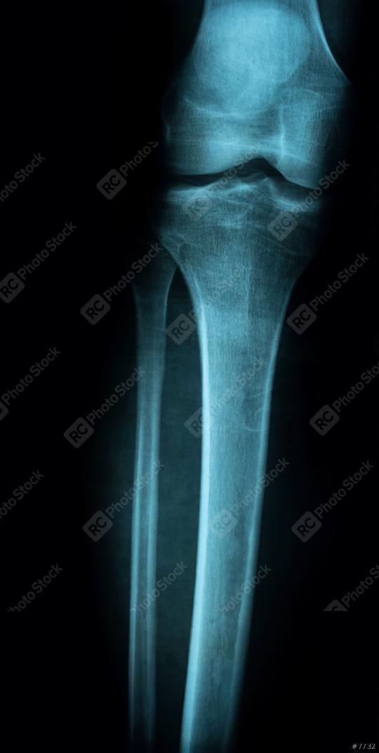 X-ray image of a leg for a medical diagnosis  : Stock Photo or Stock Video Download rcfotostock photos, images and assets rcfotostock | RC Photo Stock.: