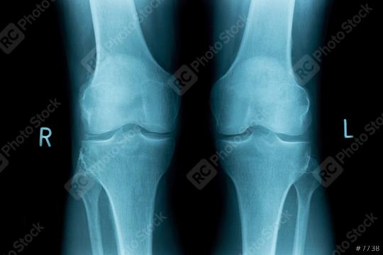 x-ray image of both human knee  : Stock Photo or Stock Video Download rcfotostock photos, images and assets rcfotostock | RC Photo Stock.: