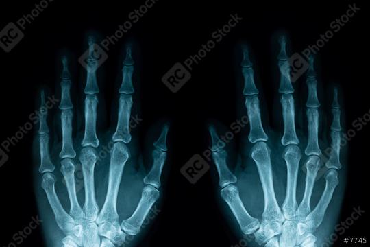 x-ray image of left and right human hands  : Stock Photo or Stock Video Download rcfotostock photos, images and assets rcfotostock | RC Photo Stock.: