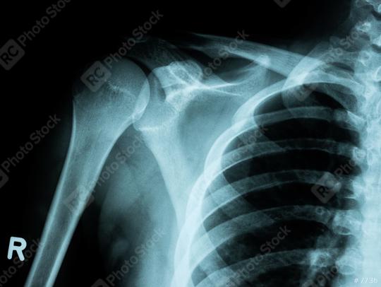 X-ray image of shoulder fracture for a medical diagnosis  : Stock Photo or Stock Video Download rcfotostock photos, images and assets rcfotostock | RC Photo Stock.: