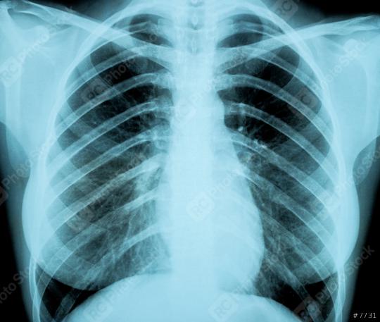 X-Ray Image Of Woman Chest for a medical diagnosis  : Stock Photo or Stock Video Download rcfotostock photos, images and assets rcfotostock | RC Photo Stock.: