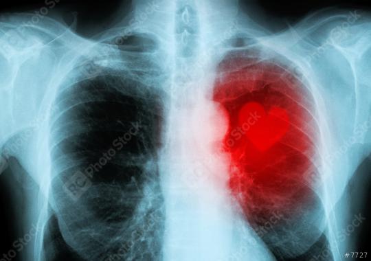 x-ray red heart of human (heart disease)  : Stock Photo or Stock Video Download rcfotostock photos, images and assets rcfotostock | RC Photo Stock.: