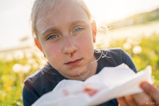 young girl with a nosebleed holds a blood-stained tissue, looking distressed. The outdoor setting with a blurred background of dandelions emphasizes the health concern and discomfort.  : Stock Photo or Stock Video Download rcfotostock photos, images and assets rcfotostock | RC Photo Stock.: